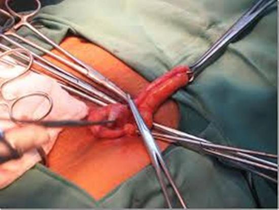 операция при аппендиците