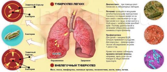 внелегочные формы туберкулеза