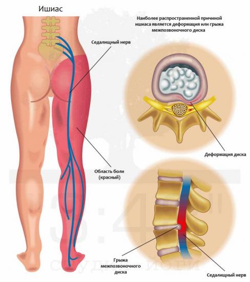 анатомия седалищного нерва