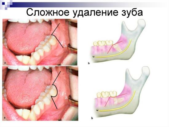 сложное удаление зуба