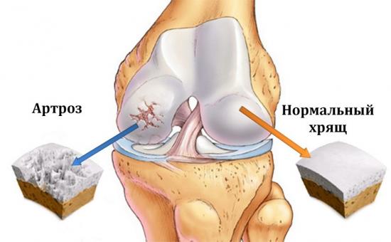 лечение артроза коленного сустава в домашних условиях