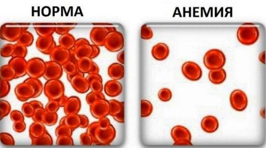 гемоглобин норма и анемия