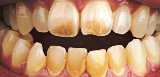 коричневый налет на наружной части зубов